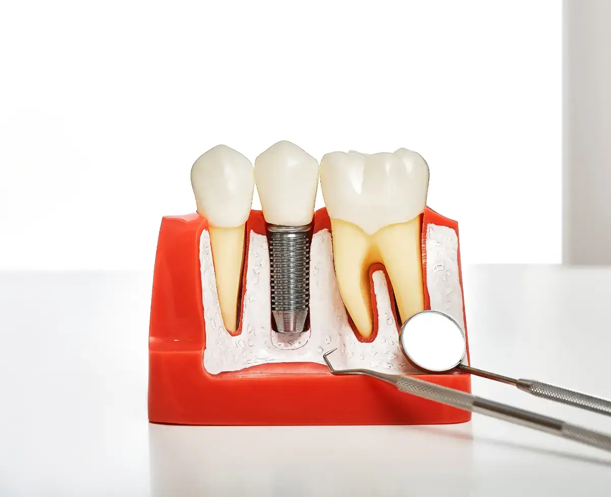Dental implants include a metal implant post, implant abutments, and crown mimicking real teeth. 