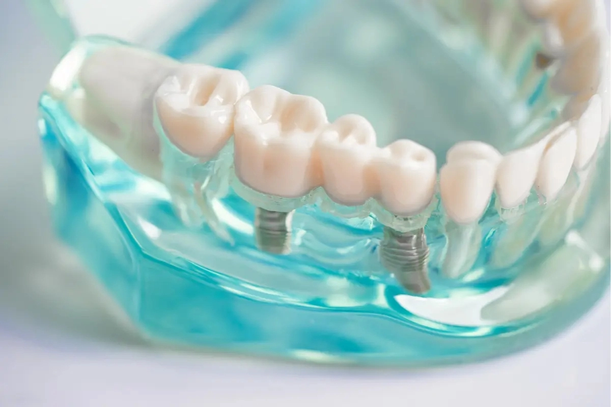An implant supported bridge offers another approach to dental implants.
