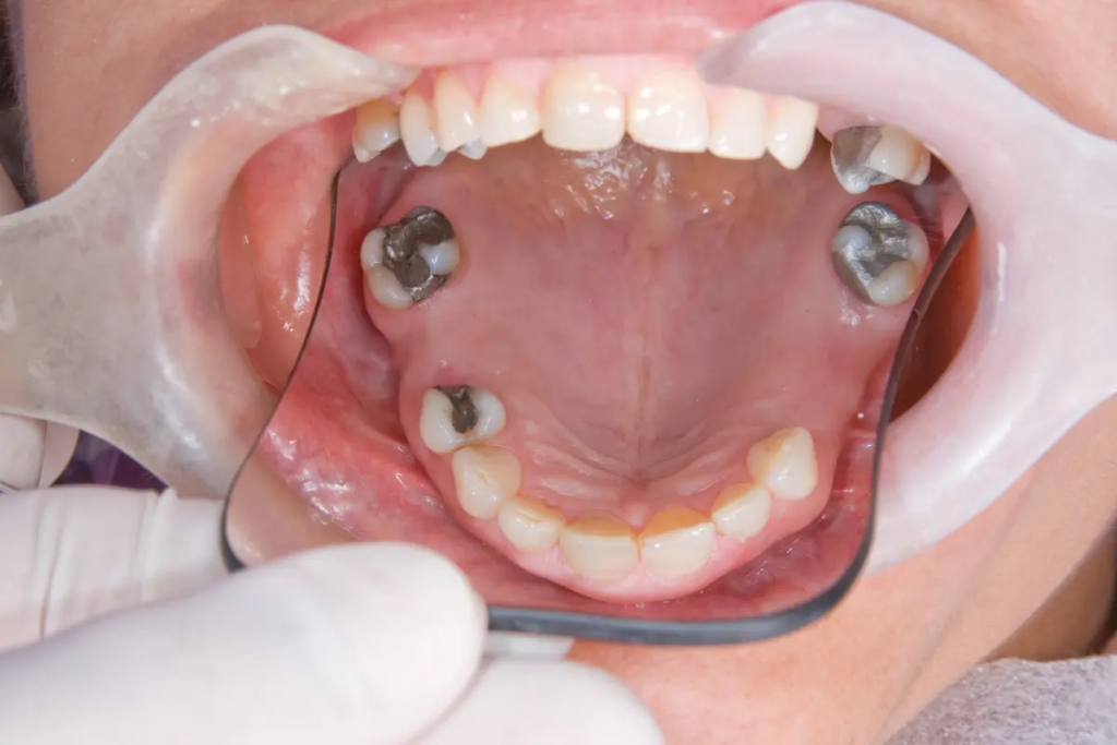 Many people consider replacing silver fillers for teeth.