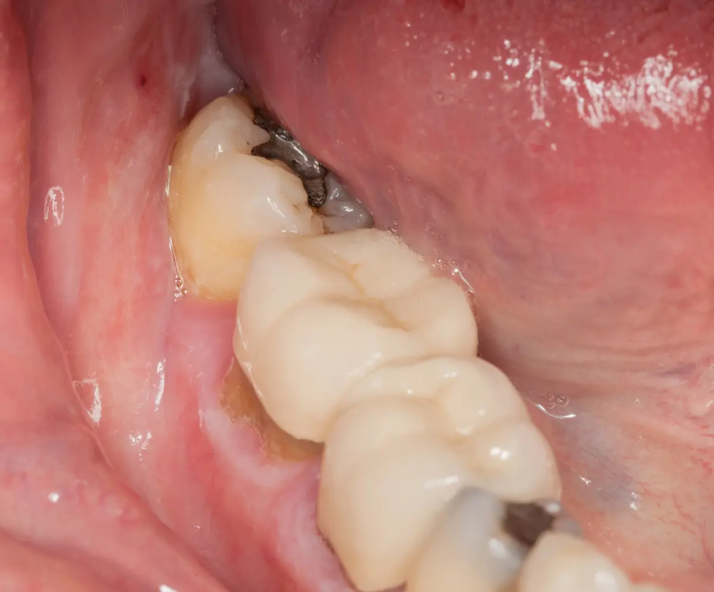 Tooth colored fillings are often preferred to silver fillers for teeth.