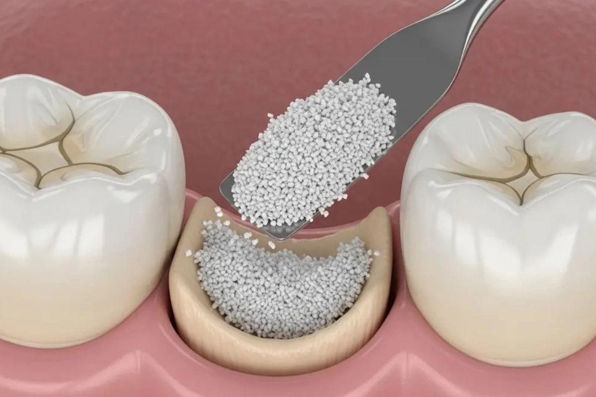 Dental implants sometimes require a bone graft as part of the treatment plan.  